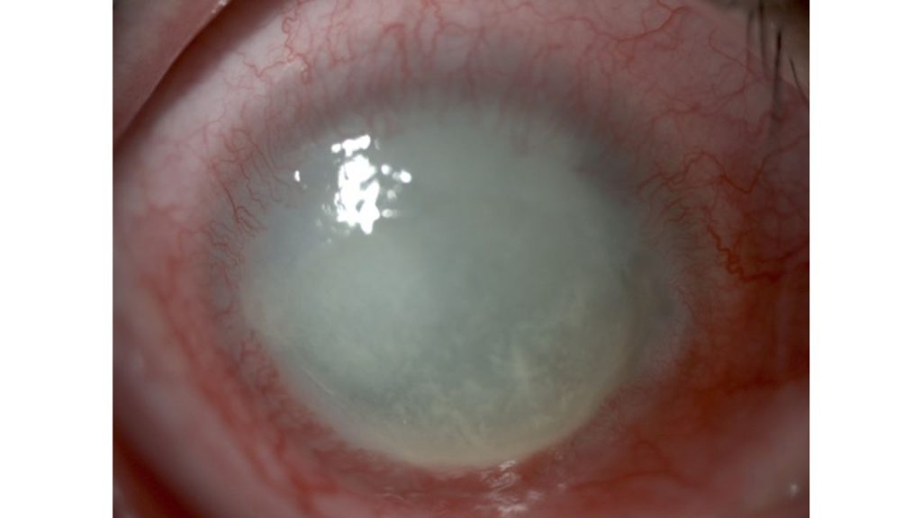 ilustrasi keratitis