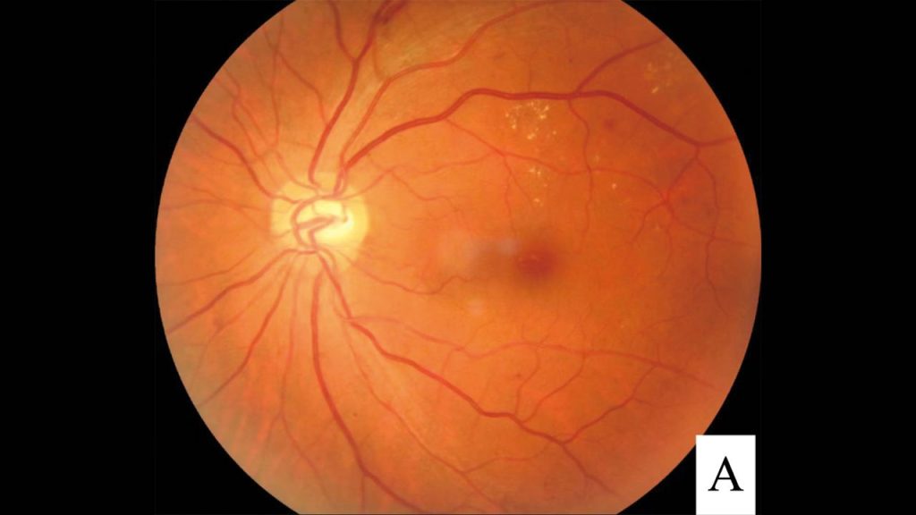ilustrasi retinopati diabetik dan hipertensi