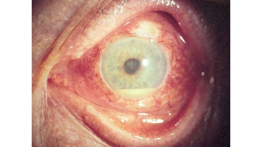 ilustrasi uveitis