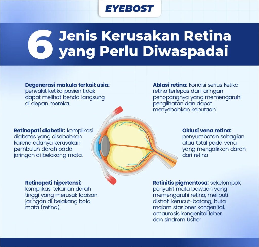 infografis jenis retina mata rusak
