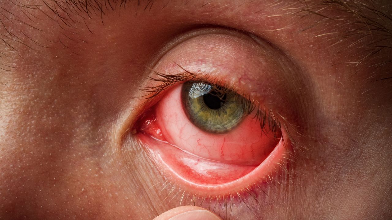 Apakah Mata Belekan Bisa Menular