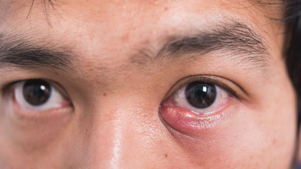 Bintitan Tidak Membaik