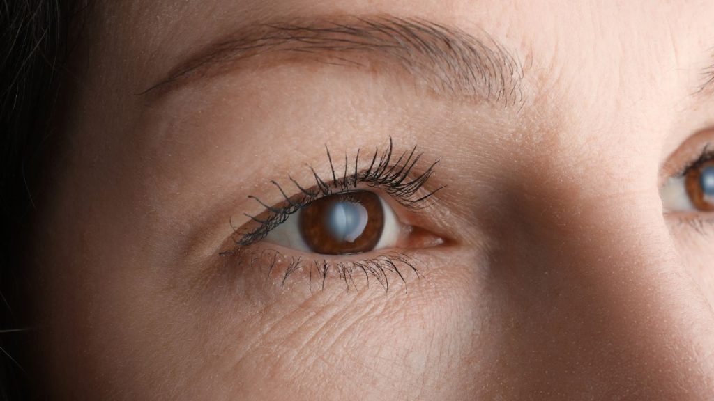 Cara Menyembuhkan Katarak Kortikal