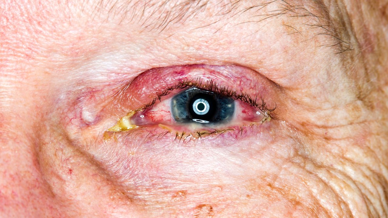 Mata Berlendir Seperti Benang