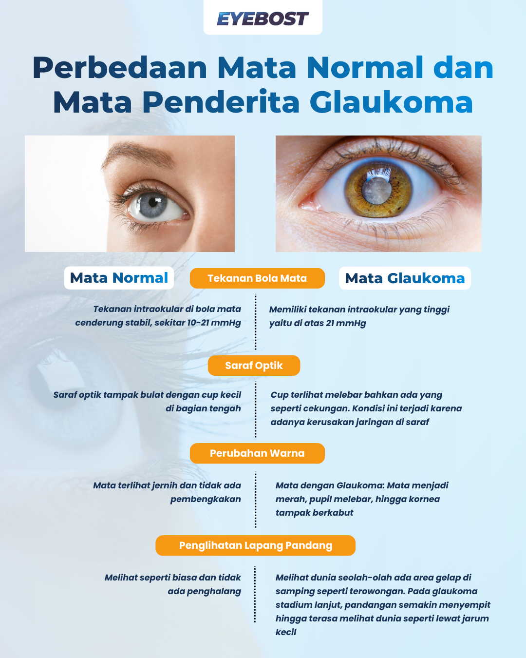 Perbedaan Mata Normal dan Mata Penderita Glaukoma