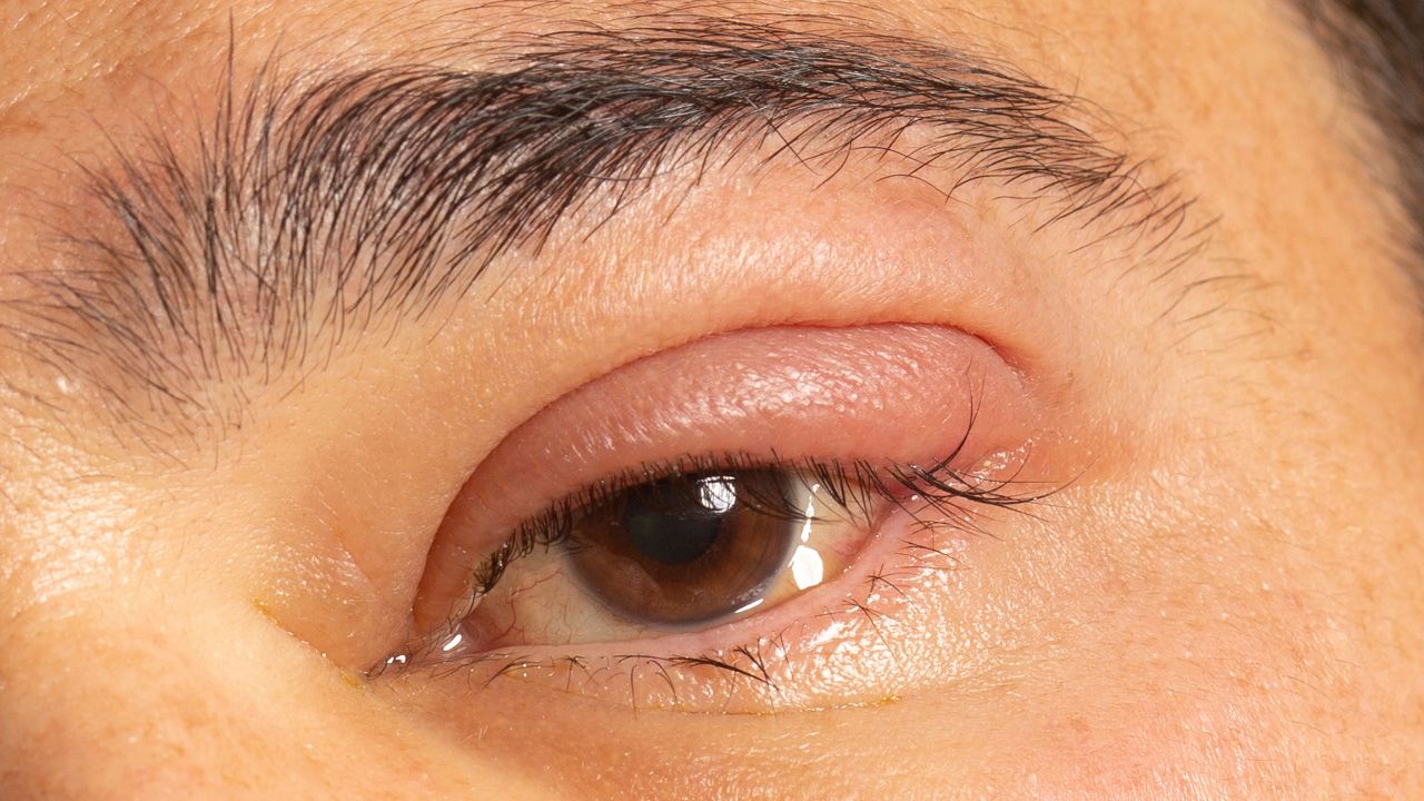 Waspada Bintitan yang Tidak Sembuh-sembuh