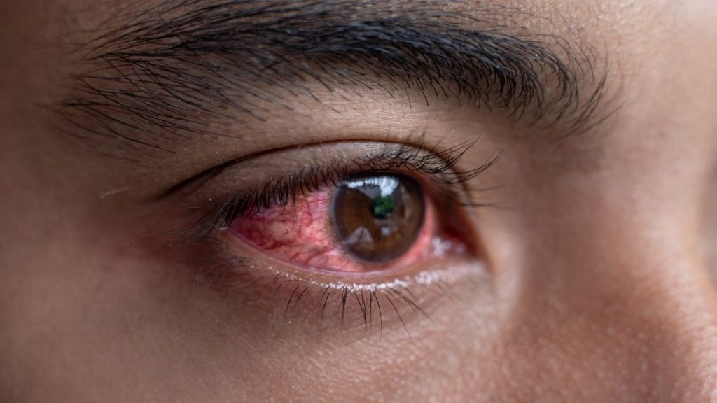 Jenis-jenis Mata Merah Jenis-jenis Mata Merah