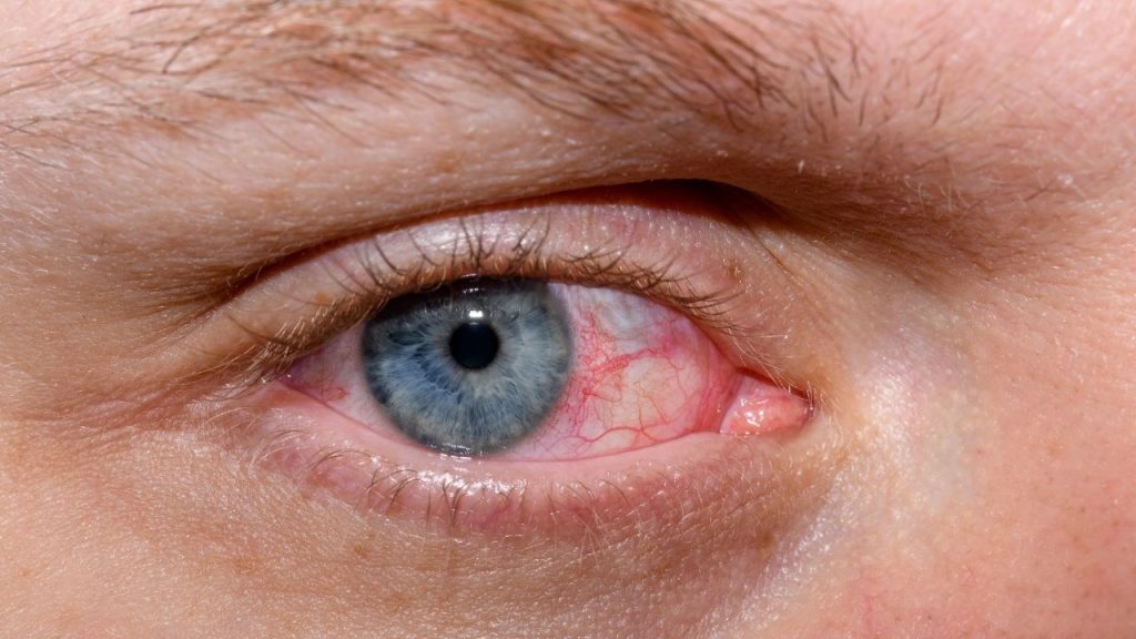 Pengobatan Mata Merah Menular Pengobatan Mata Merah Menular