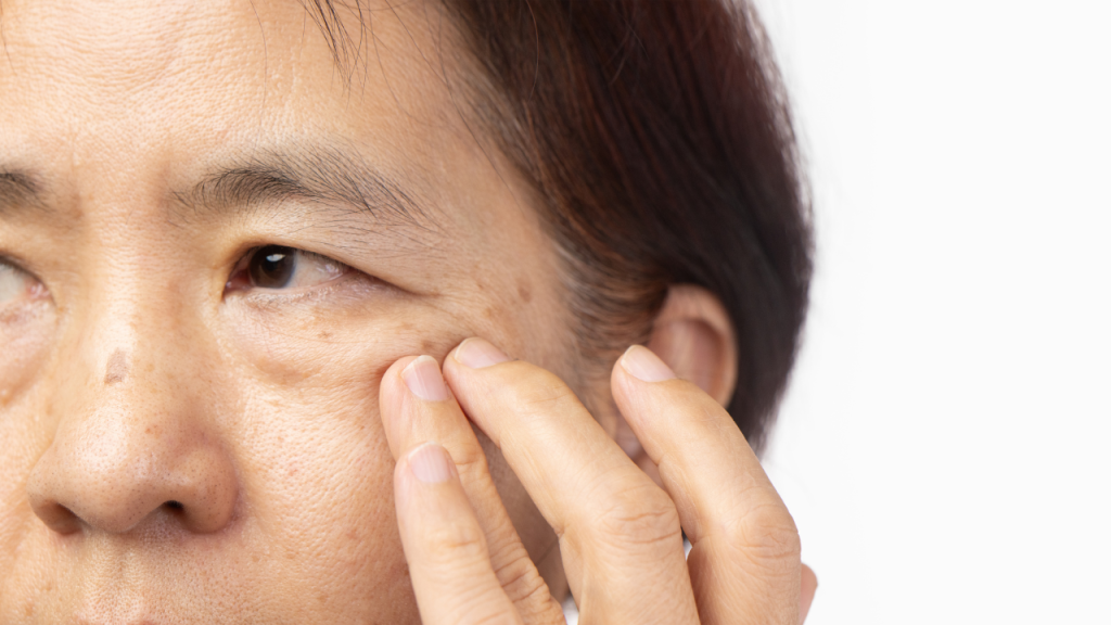 Penyebab Kantung Mata Kendur Penyebab Kantung Mata Kendur