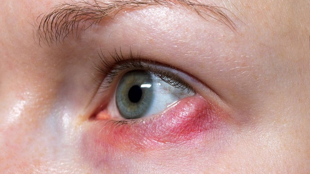 Bintitan Karena Kebanyakan Ngintip Bintitan Karena Kebanyakan Ngintip