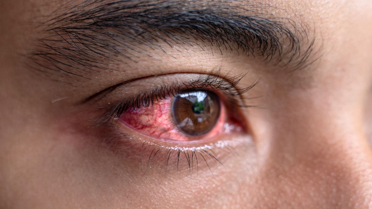 Cegah Iritasi Mata Ringan saat Ramadan