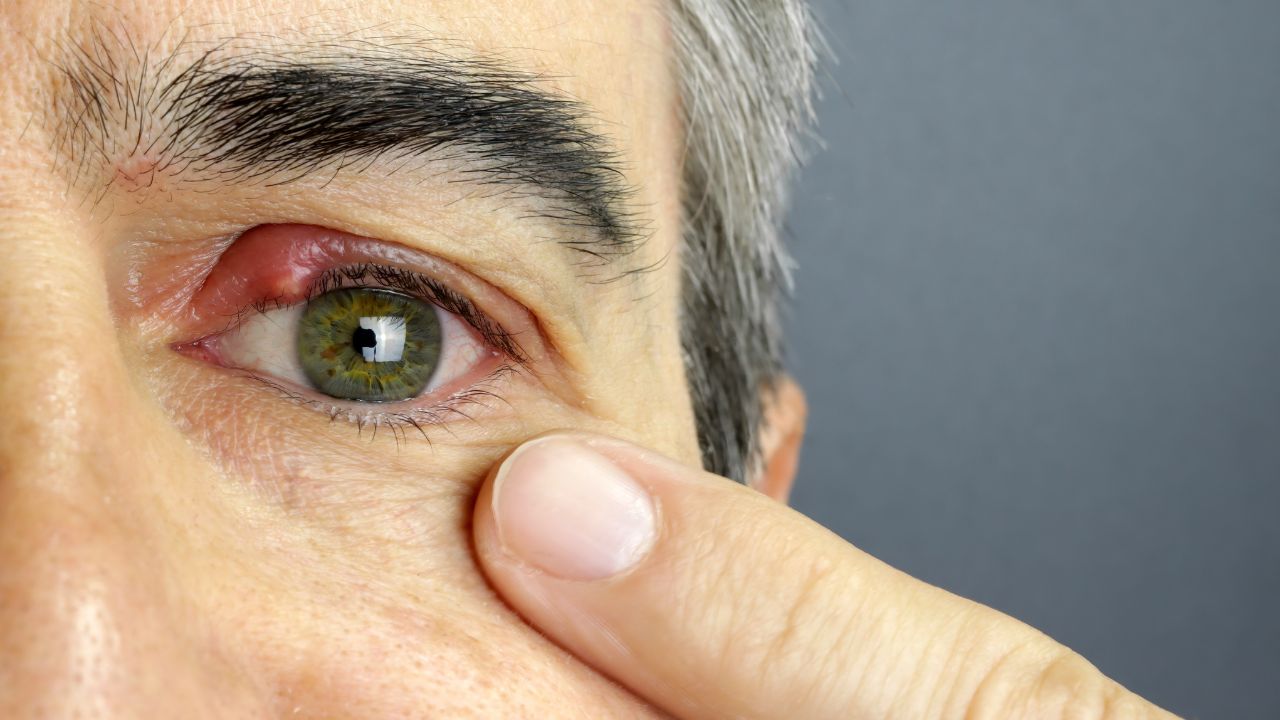 Fakta dan Mitos Mata Bintitan