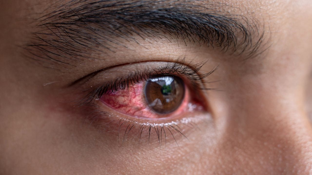 Infeksi Akibat Softlens