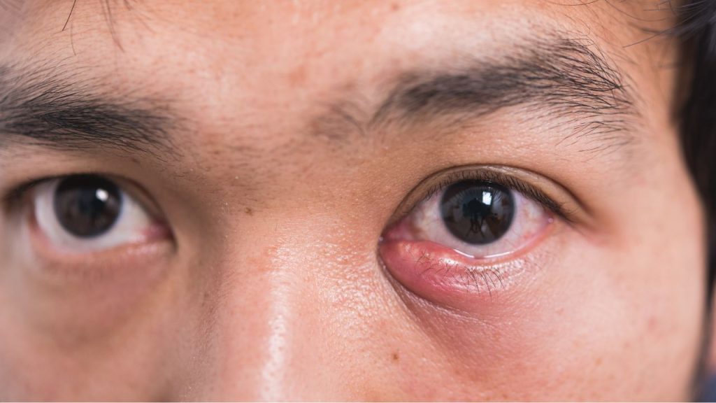 Yang Harus Kita Lakukan Jika Mengalami Bintitan Yang Harus Kita Lakukan Jika Mengalami Bintitan