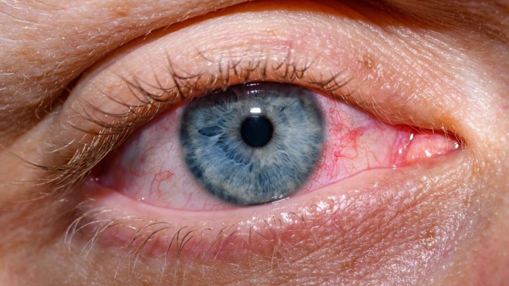 Gangguan Mata yang Sering Terjadi Pasca Lebaran