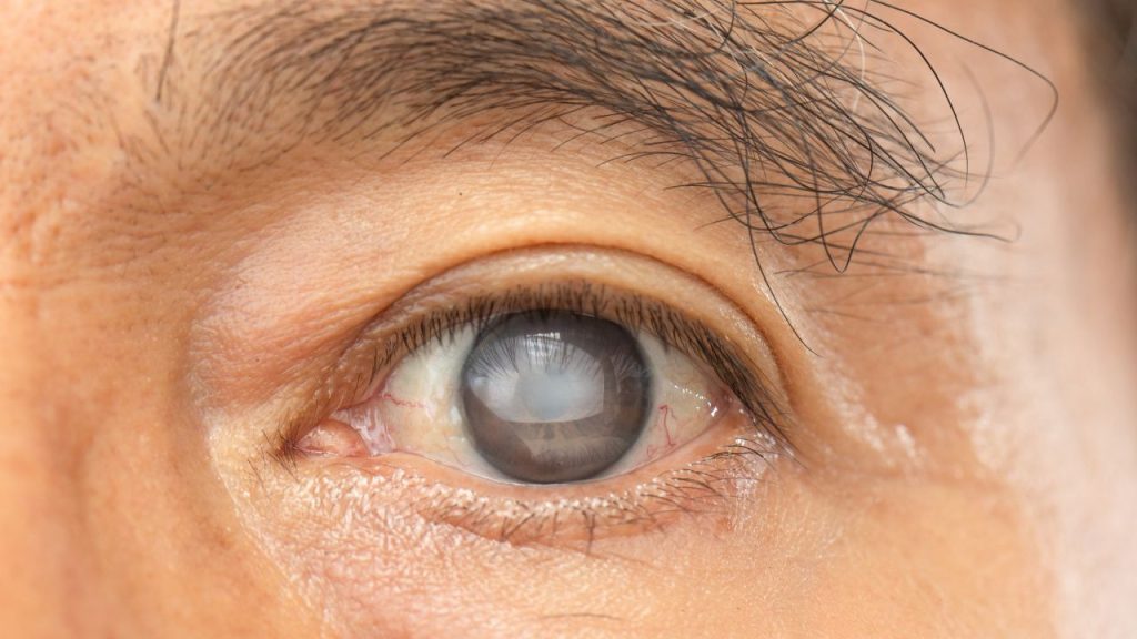 Jenis Penyakit Mata Yang Perlu Diwaspadai Pasca Idul Fitri