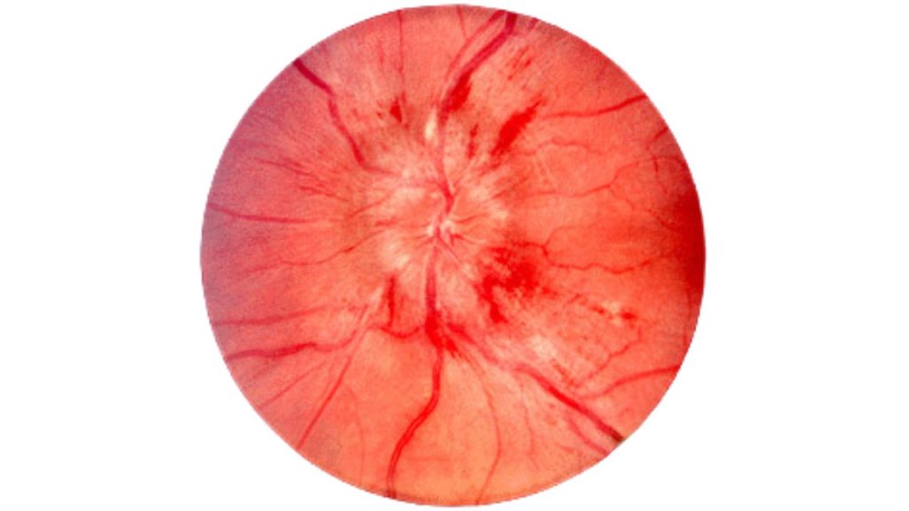 Penyebab Papiledema